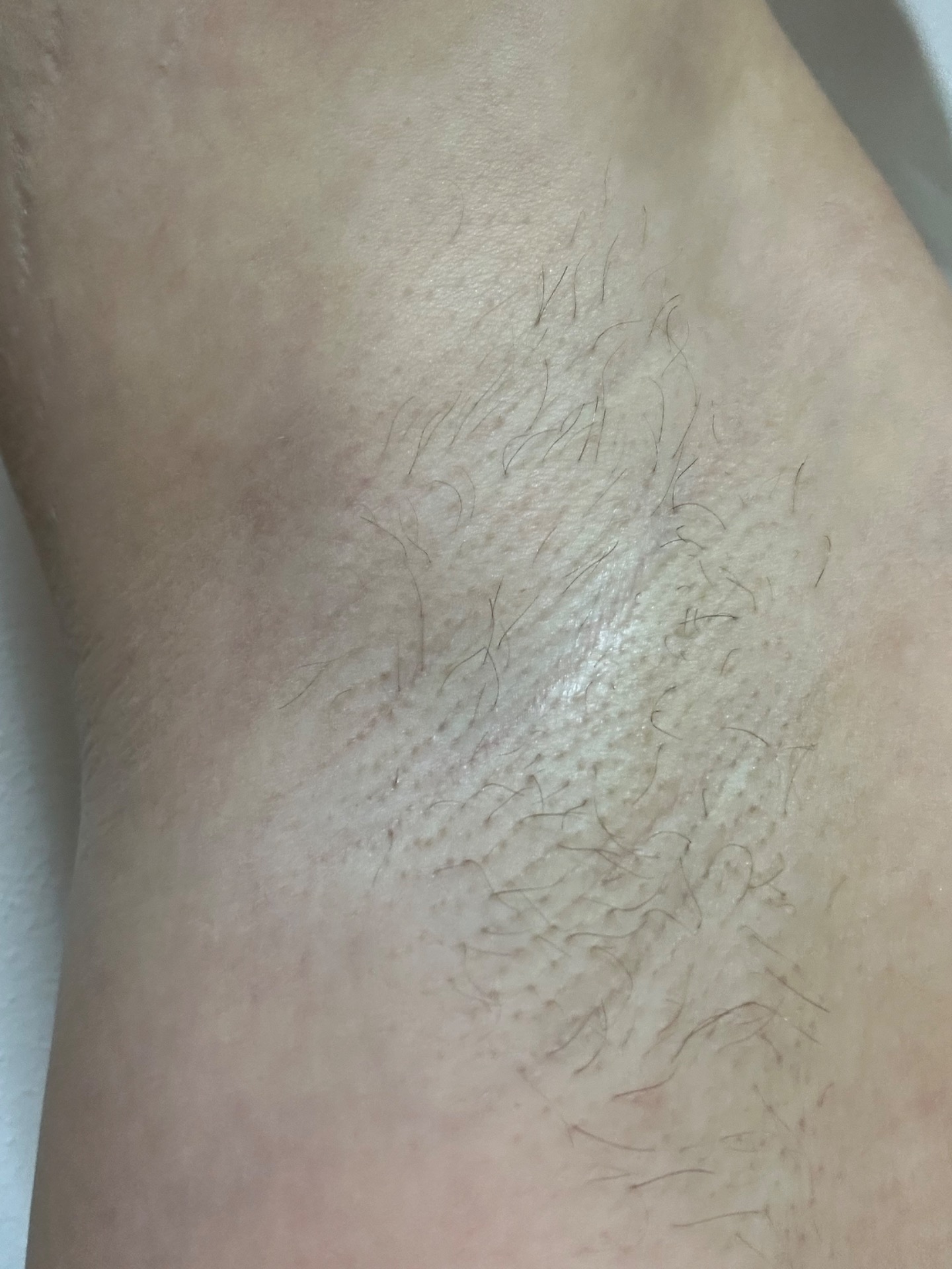 Ipl laser po prvním ošetření 